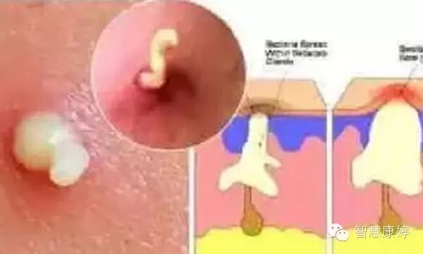 痘痘里面挤出来的白色东西是什么,怎么解决?